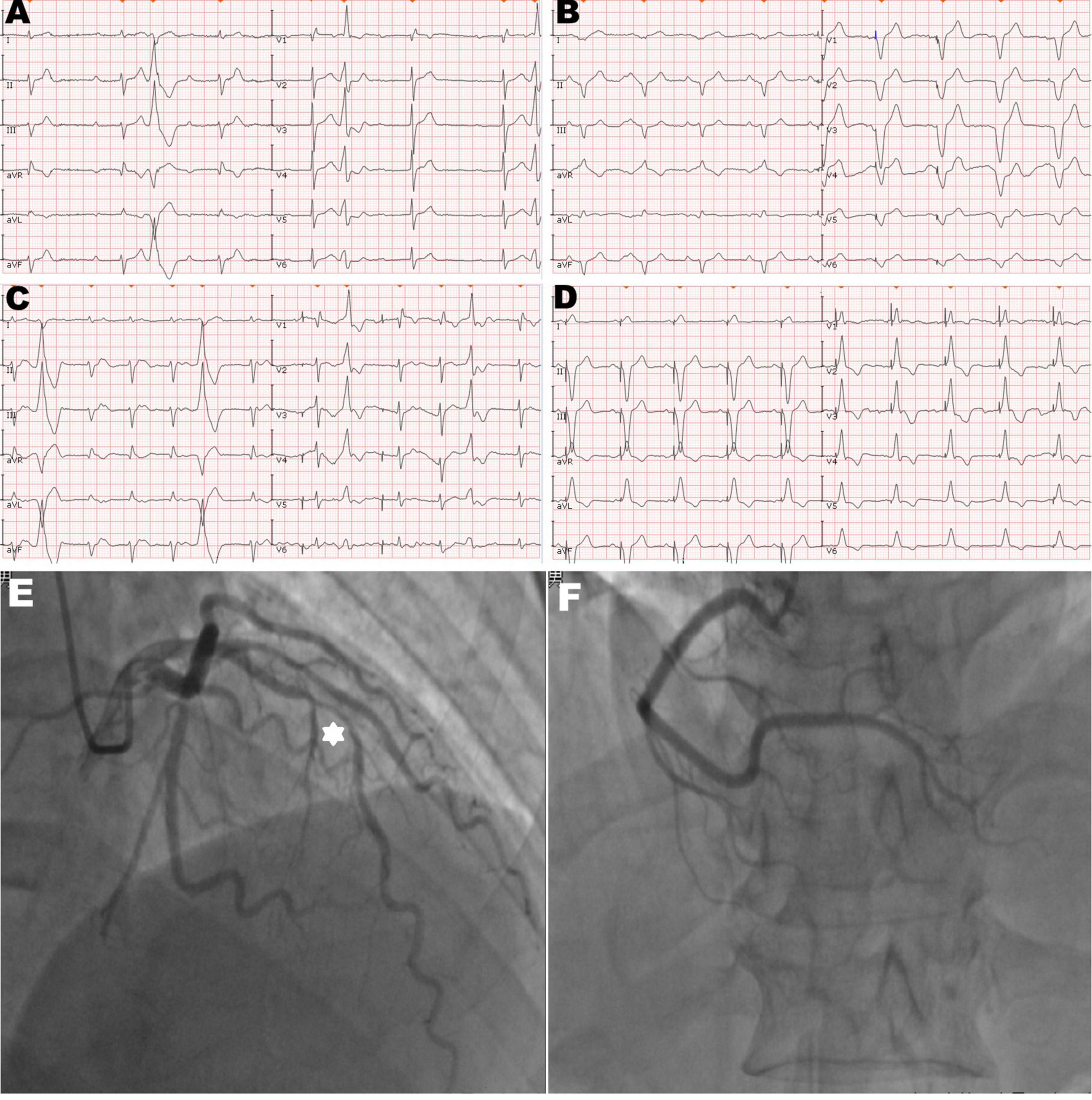 Case report: Left ventricular perforation caused by right ventricular pacemaker lead